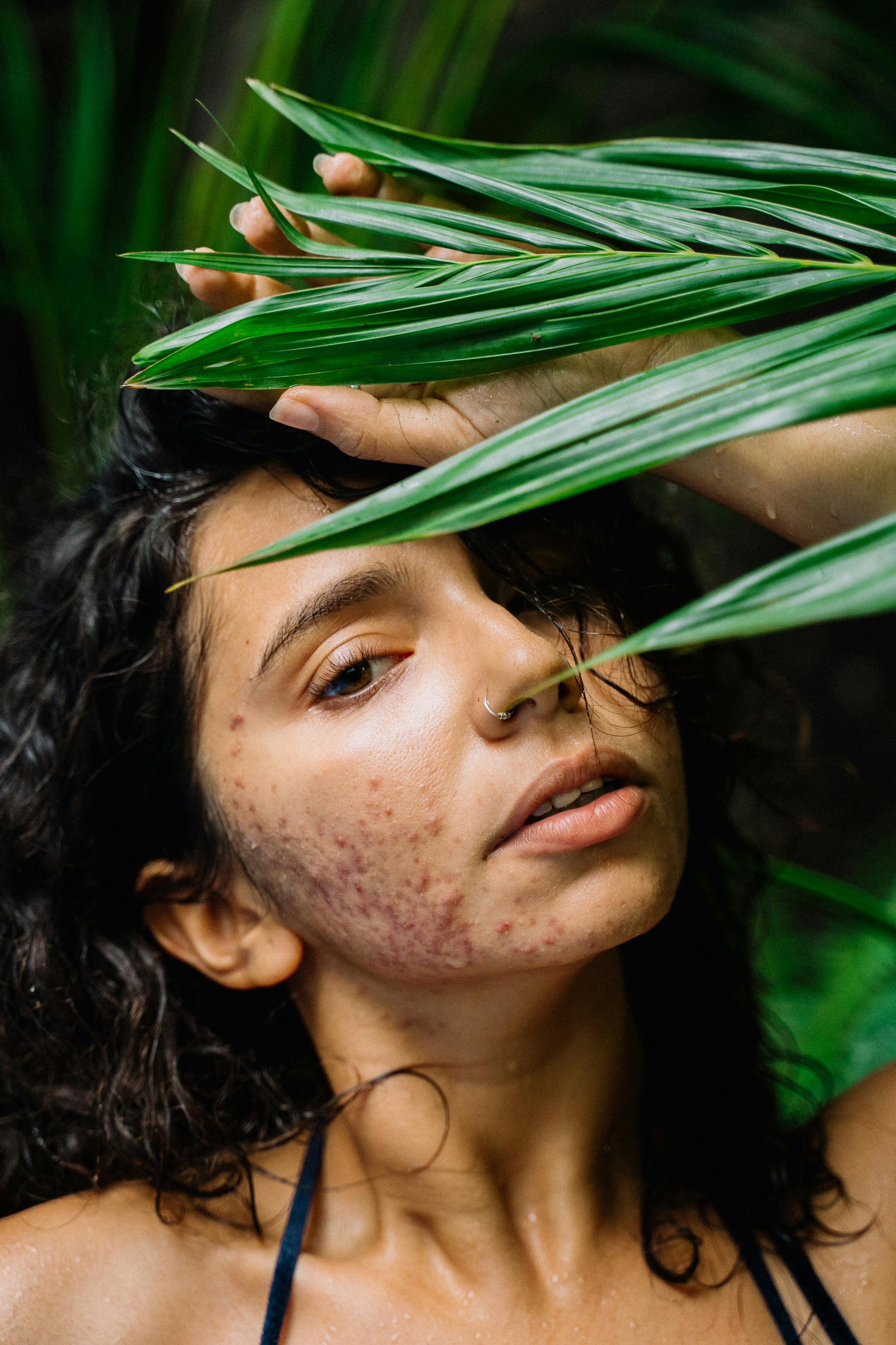 Facial Acne: Exploring Problems, Causes and Remedies 